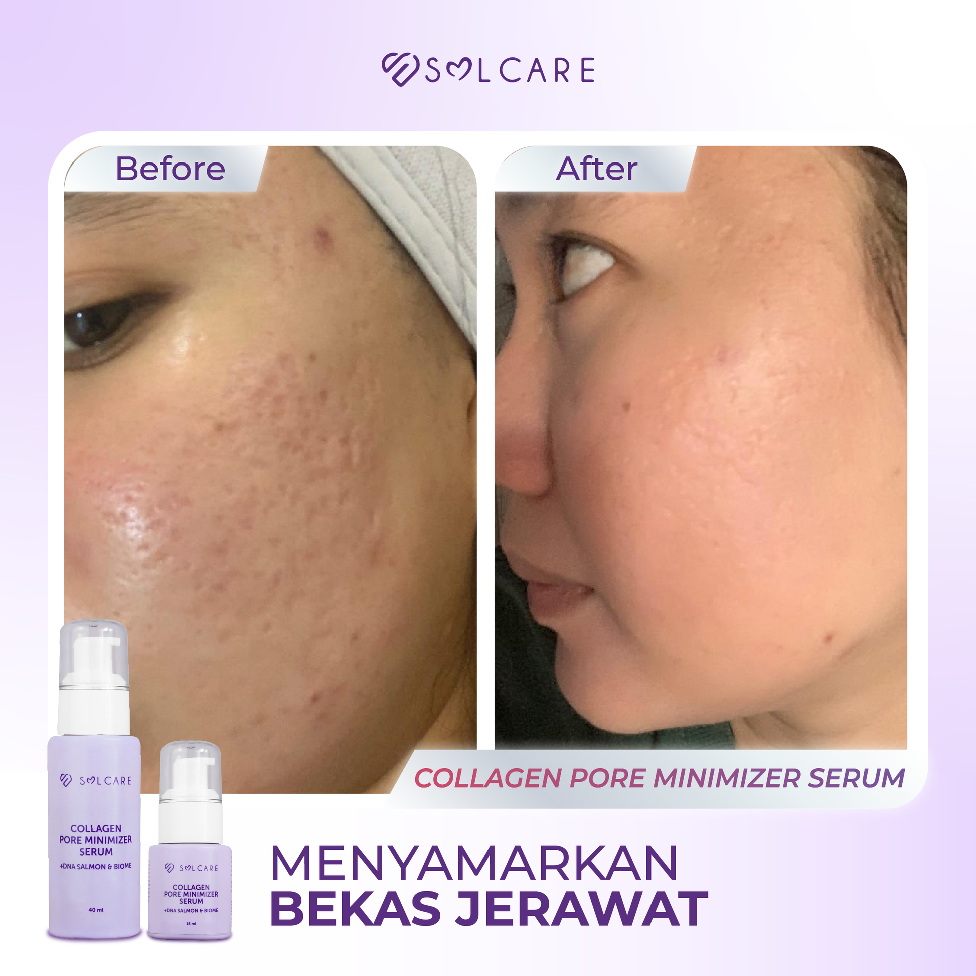 Collagen Serum Bekas Jerawat