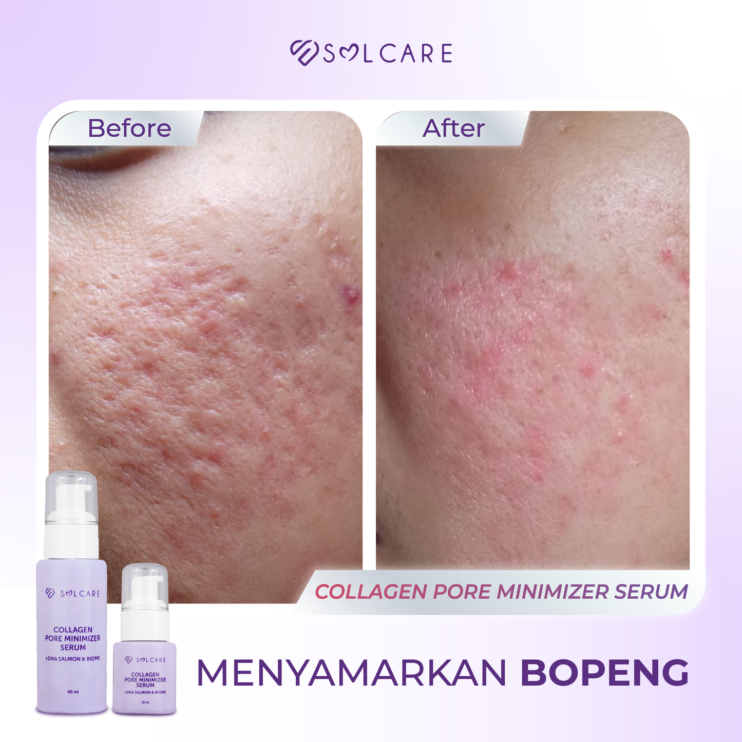 Collagen Serum Wajah Bopeng