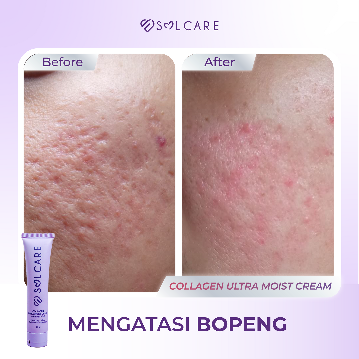 Collagen Cream Mengatasi Bopeng